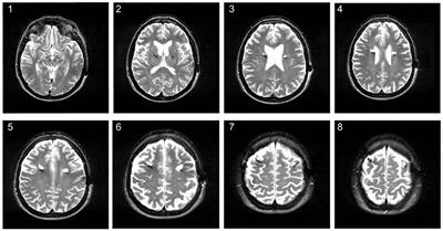 White Matter Changes Along the Electrode Lead in Patients Treated With Deep Brain Stimulation